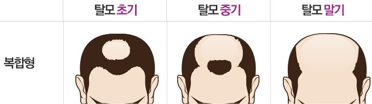 탈모 놀리던 만화가의 최후.jpg