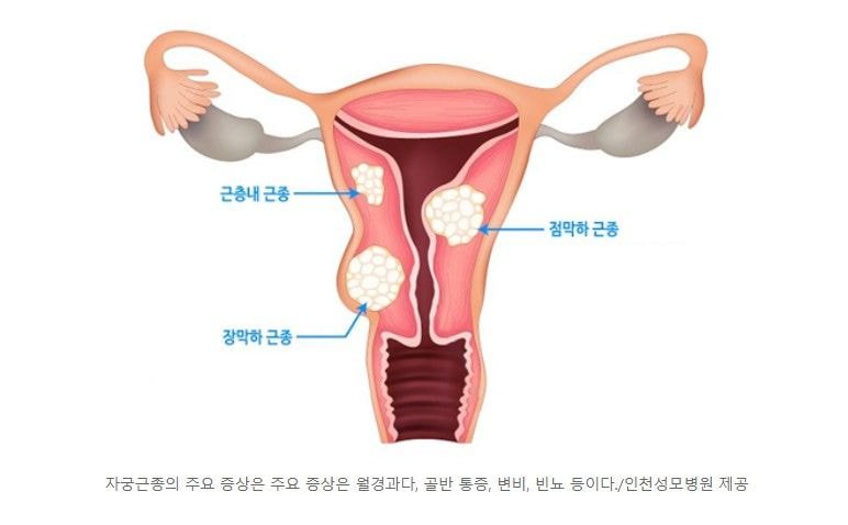 요즘 2030여성들에게 급증하고 있다는 종양.jpg