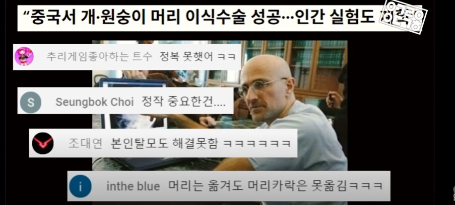 머리 이식수술